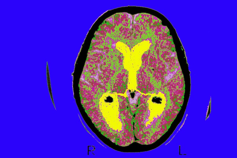 Un escáner cerebral de un paciente con Alzheimer